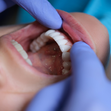 Dental Bridges and Crowns LaSalle Dentist Windsor